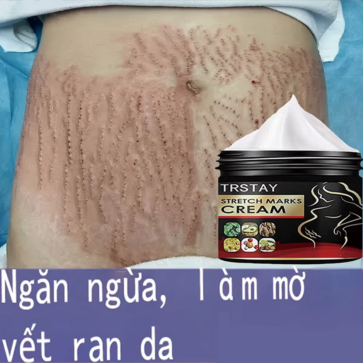 TRSTAY crème contre les vergetures pour la peau de grossesse reconstituer et réparer la Promotion de