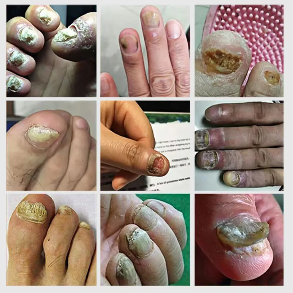Sérum de traitement des champignons des ongles, liquide de réparation des pieds, Gel d'élimination d