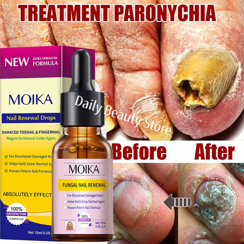 Sérum de traitement fongique des ongles, élimination des champignons des pieds, Gel de réparation, A