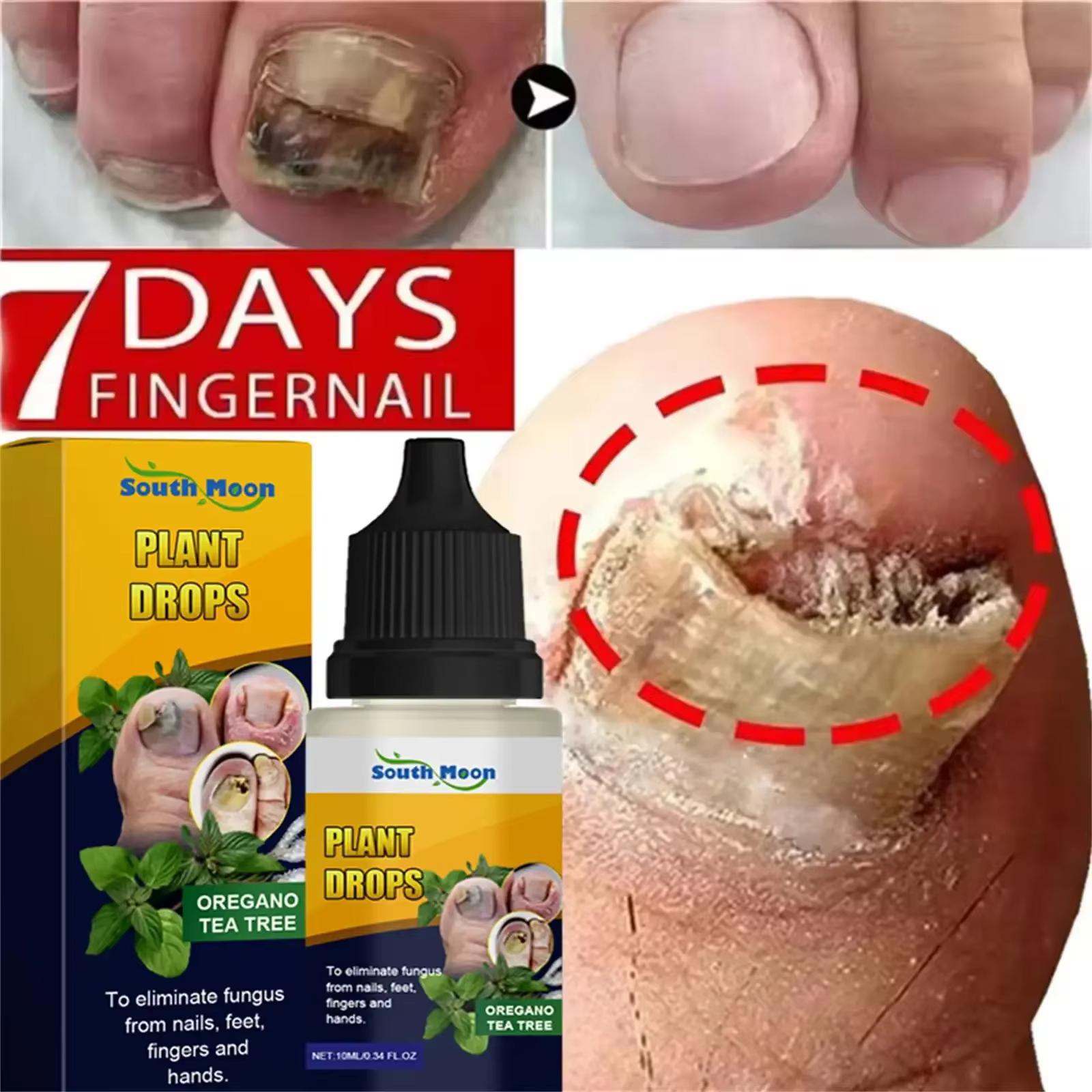 7 jours traitements fongiques des ongles sérum liquide Anti-Infection onychomycose Paronychia soin d