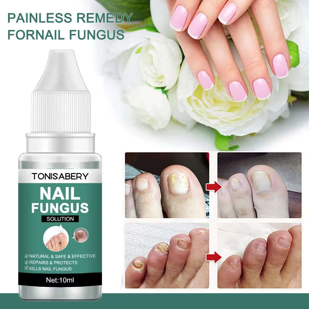 Sérum de traitement des champignons des ongles, liquide de réparation des pieds, Gel d'élimination d