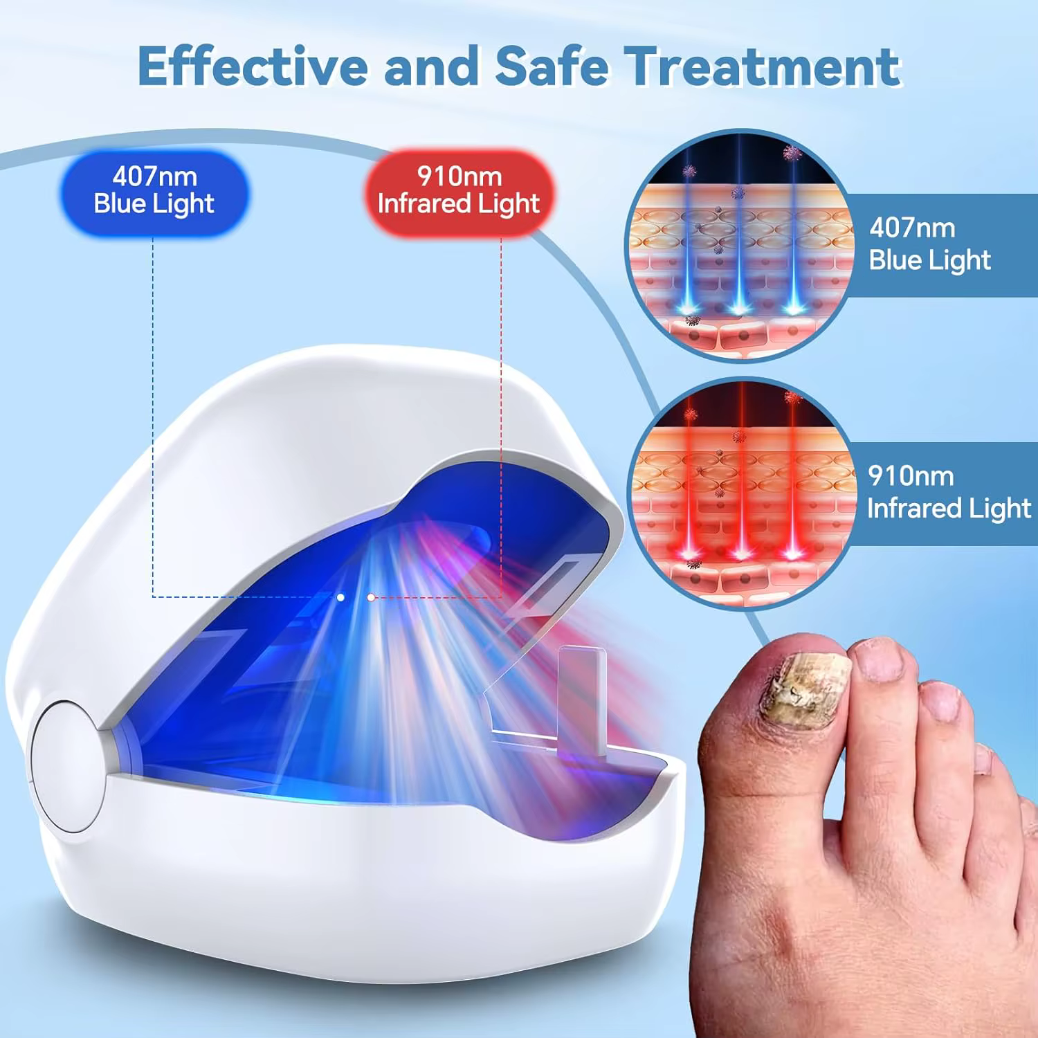 Dispositif Laser fongique pour réparation des ongles des pieds