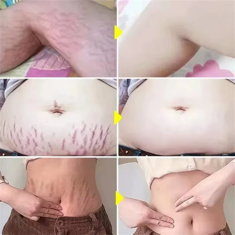 Crème anti-vergetures permanente 100g pour femmes enceintes, soin corporel lissant, réparateur et raffermissant pour la peau