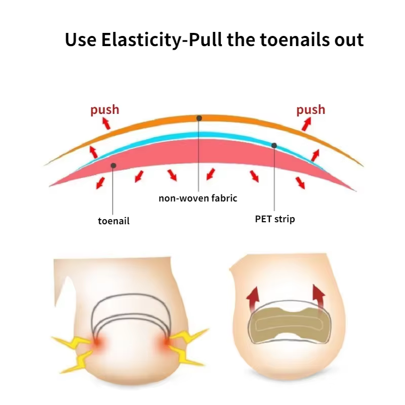 Autocollants de Correction des ongles incarnés