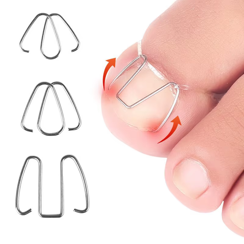 Outil de Correction des ongles incarnés, orthèse des ongles, Clip Paronychia