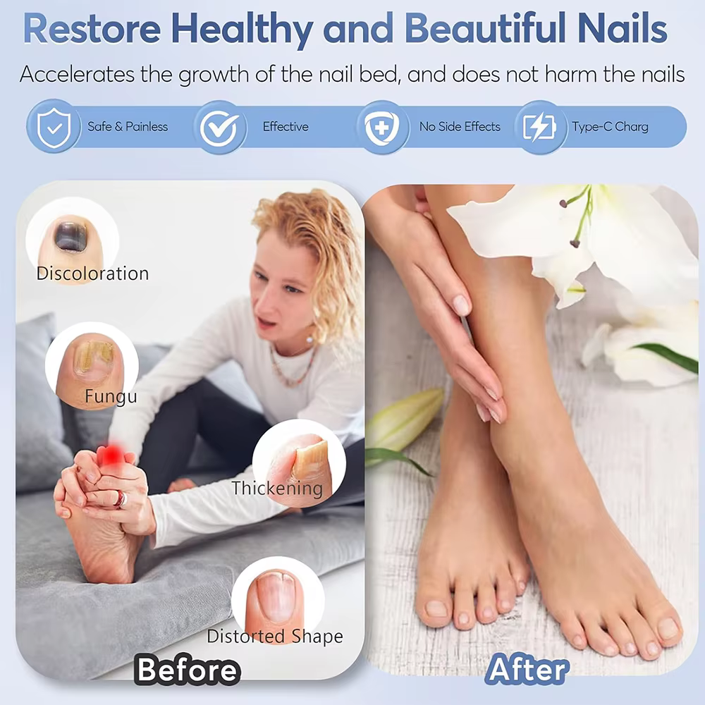 Dispositif de traitement au Laser pour champignons des ongles