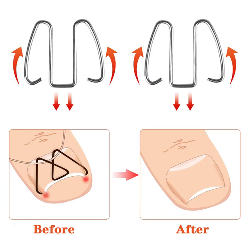Outil de Correction des ongles incarnés, orthèse des ongles, Clip Paronychia
