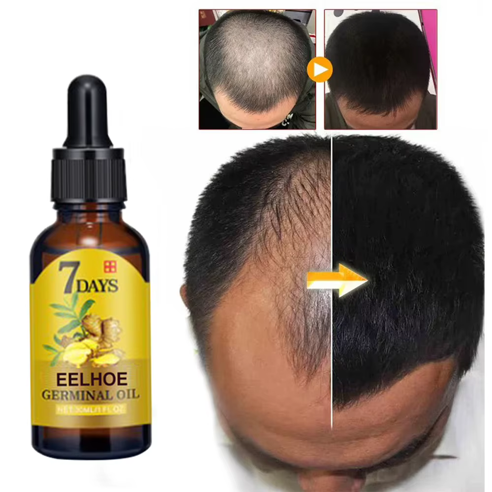 EELHOE – huile de gingembre pour la croissance des cheveux, pour le Massage du cuir chevelu, traitement des follicules pileux, soins capillaires, Essence germinale pour la repousse et la perte