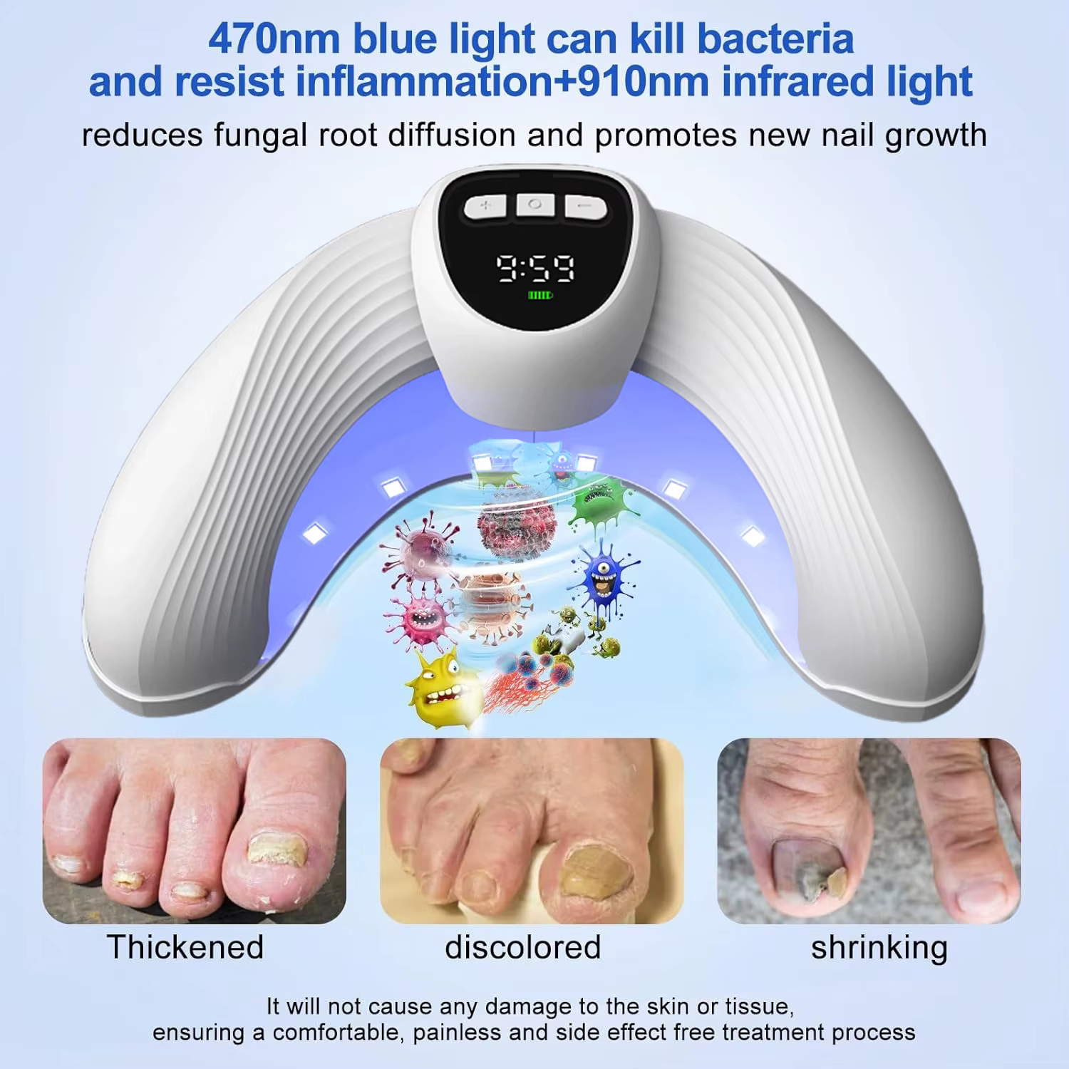 Dispositif laser de traitement des champignons des ongles – Élimine