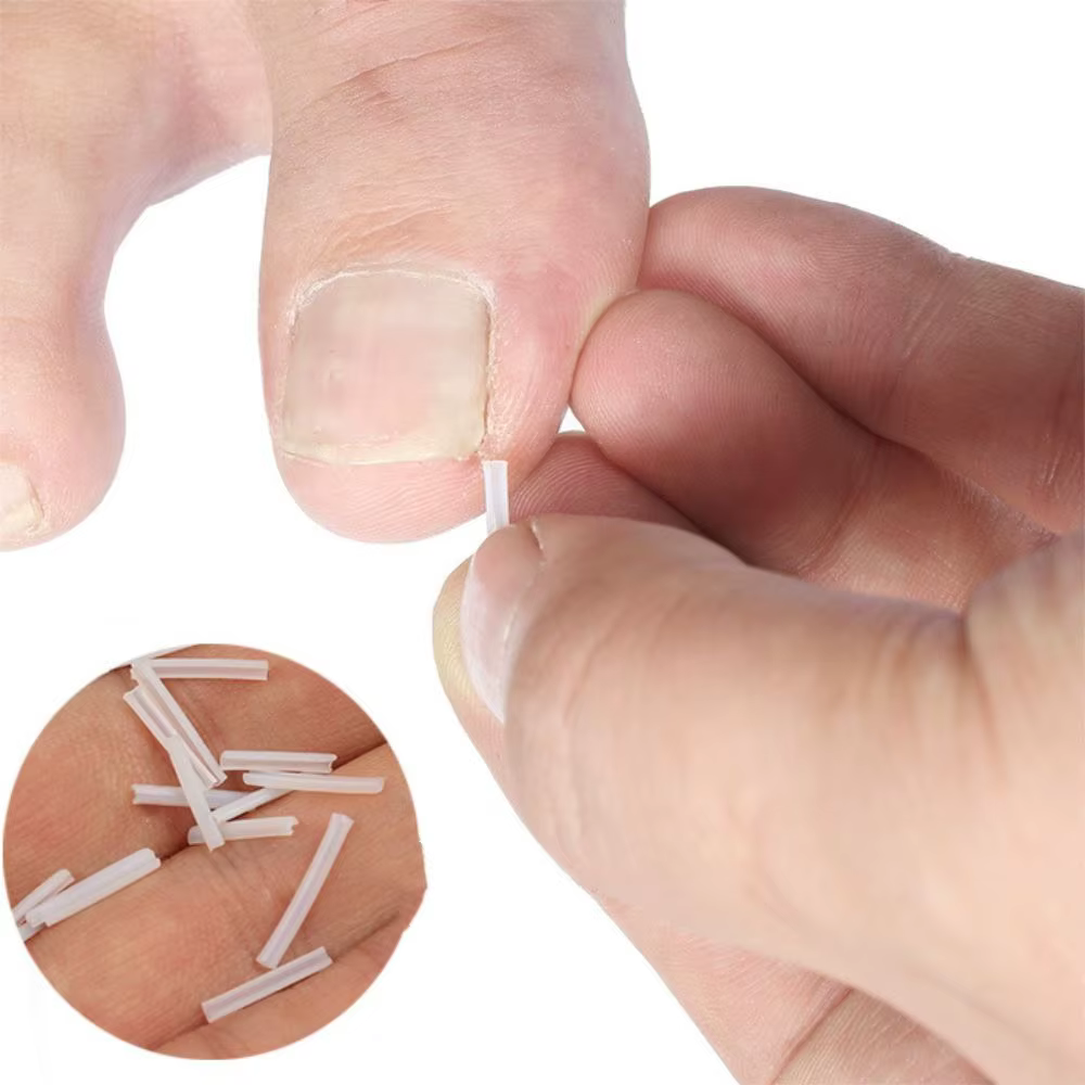 Outil de Correction des ongles incarnés
