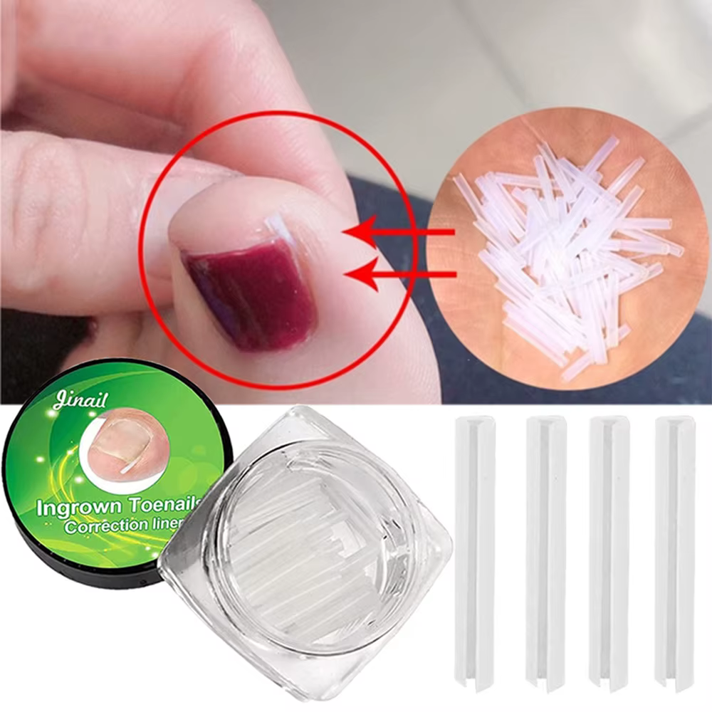 Outil de Correction des ongles incarnés