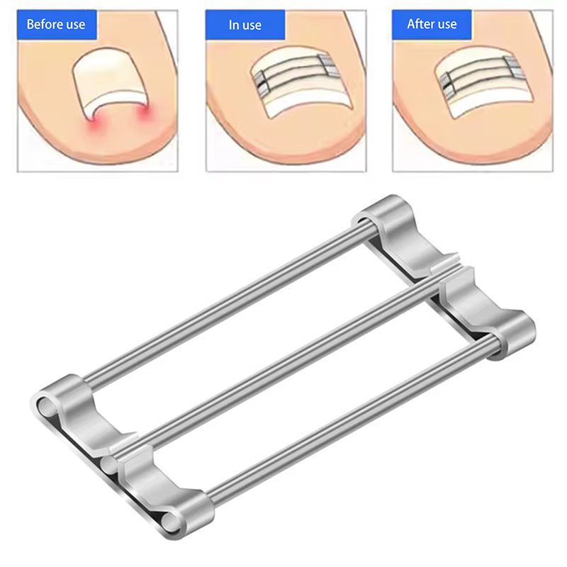 Correcteur d'ongles incarnés